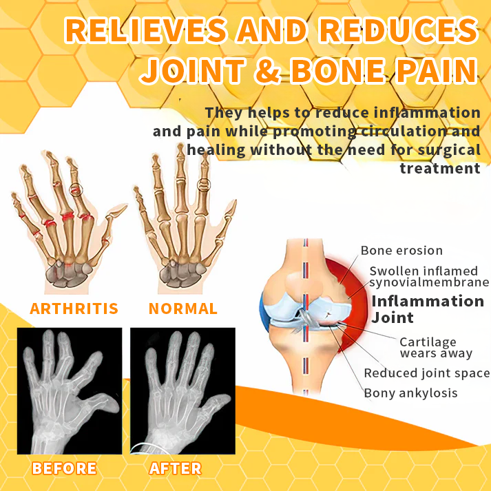 BeeSoothe™ | Arthritis & Gelenk Gel