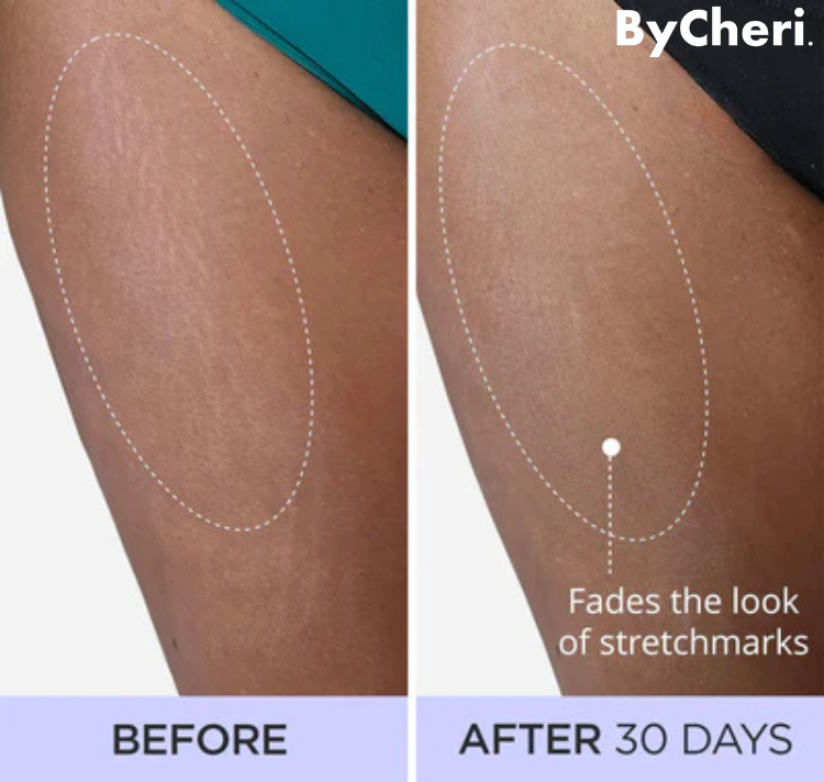1 + 1 GRATIS HEUTE | SmoothSculpt™ | Sagen Sie Hallo zu einer sichtbar strafferen Haut!