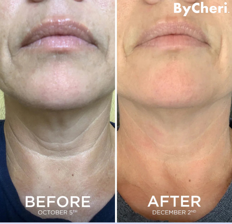 1 + 1 GRATIS HEUTE | SmoothSculpt™ | Sagen Sie Hallo zu einer sichtbar strafferen Haut!