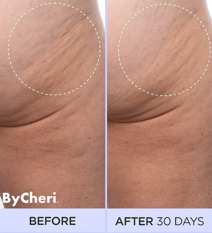 1 + 1 GRATIS HEUTE | SmoothSculpt™ | Sagen Sie Hallo zu einer sichtbar strafferen Haut!