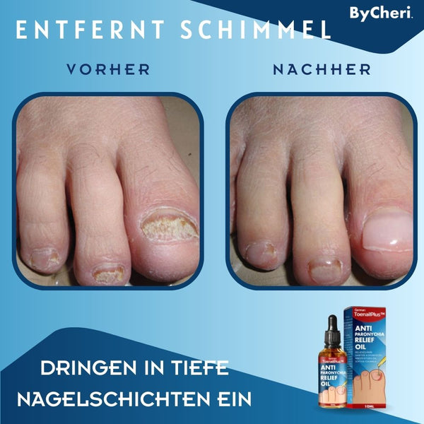 ToePerfect™ - Heilt Zehen- und Handnägel | 1+1 GRATIS TEMPORÄR - ByCheri