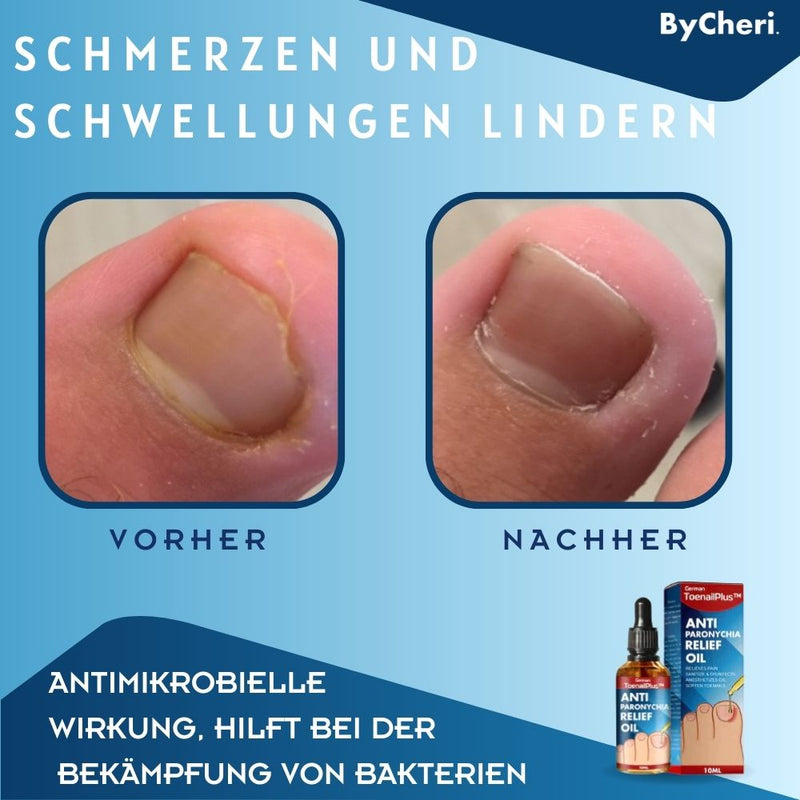 ToePerfect™ - Heilt Zehen- und Handnägel | 1+1 GRATIS TEMPORÄR - ByCheri