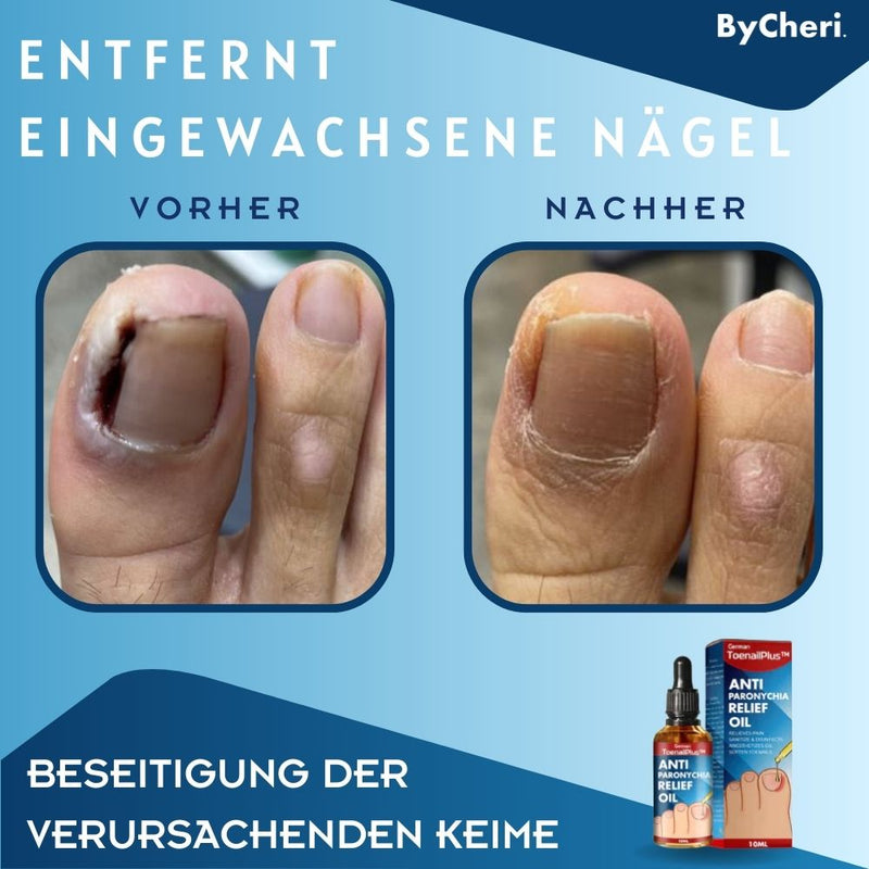 ToePerfect™ - Heilt Zehen- und Handnägel | 1+1 GRATIS TEMPORÄR - ByCheri