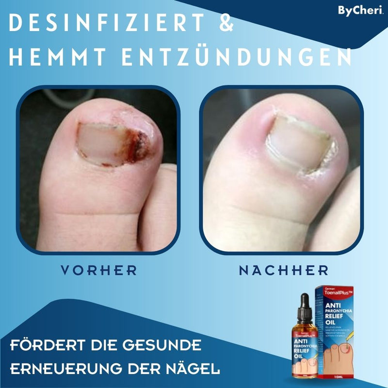 ToePerfect™ - Heilt Zehen- und Handnägel | 1+1 GRATIS TEMPORÄR - ByCheri