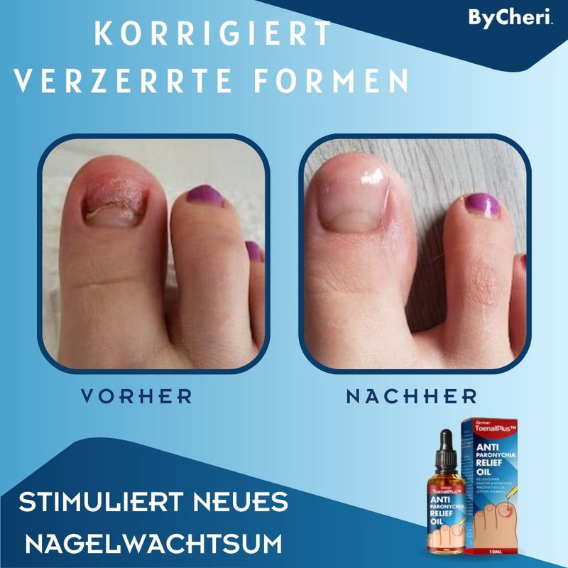 ToePerfect™ - Heilt Zehen- und Handnägel | 1+1 GRATIS TEMPORÄR - ByCheri