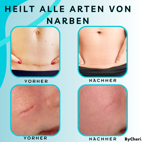 ByeScar™ - Gel zur Narbenentfernung - ByCheri