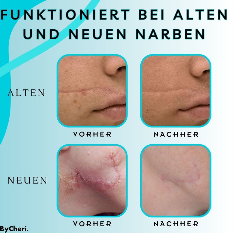 ByeScar™ - Gel zur Narbenentfernung - ByCheri