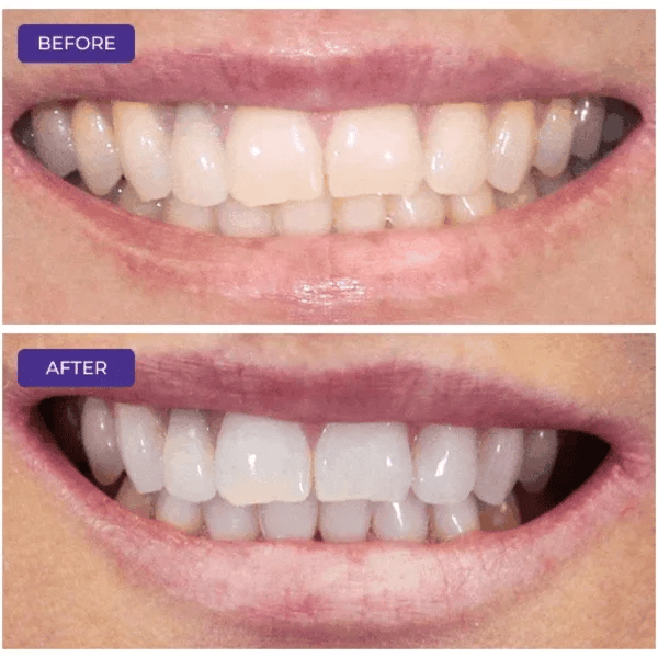 1 + 1 GRATIS HEUTE  LumaSmile™