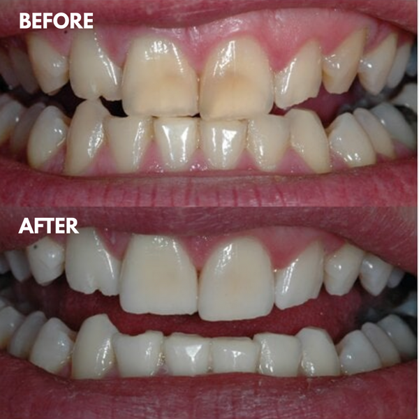 1 + 1 GRATIS HEUTE | LumaSmile™