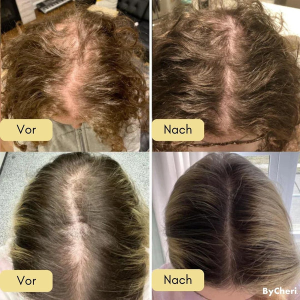 VitalGrow™ |  Ihre natürliche Ölbehandlung für Haarwachstum | 50% RABATT