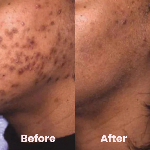 Kurkuma-Kojisäure Pads, 40 Stück – Peeling-Pads Gegen Dunkle Flecken, Mit Kamille & Zitrone