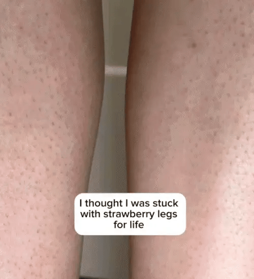 1 + 1 GRATIS HEUTE  DermaBare™ 