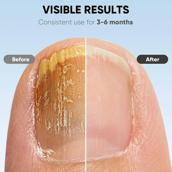 50% OFF TEMPORÄR | NailCure™