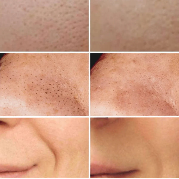 50% OFF TEMPORÄR | SkinSonic™