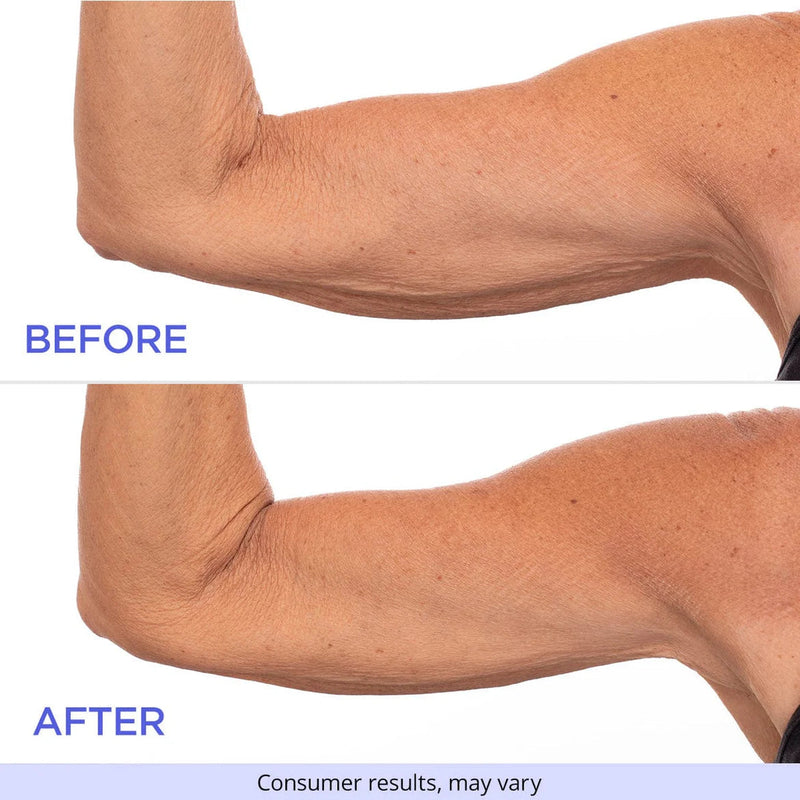 50% RABATT TEMPORÄR | SmoothSculpt™ | Sagen Sie Hallo zu sichtbar strafferen Armen!