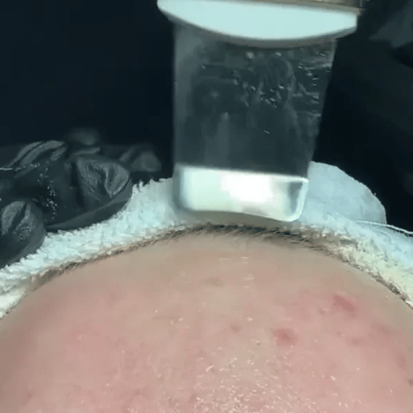 50% OFF TEMPORÄR  SkinSonic™