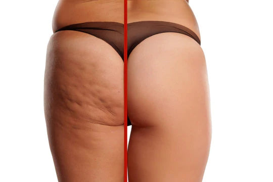 SLIMMING CELLULITE-ENTFERNER - ByCheri