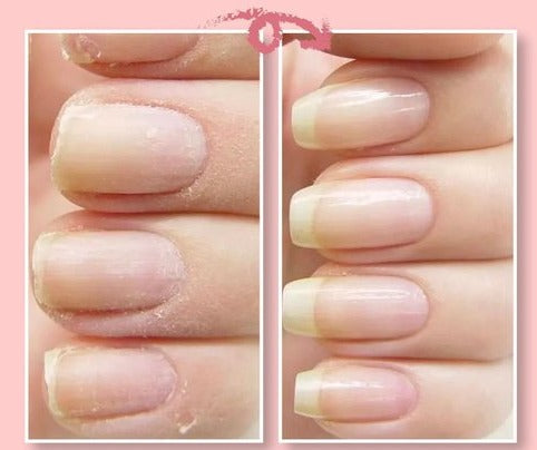 FavNail™ - Repair your broken nails - ByCheri