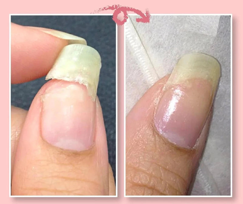 FavNail™ - Repair your broken nails - ByCheri